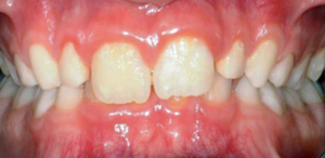 malposizione della mandibola